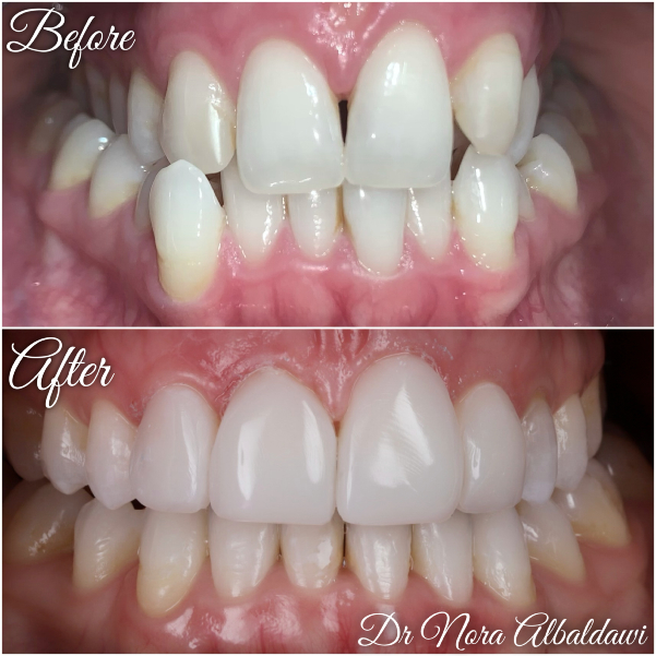 Teeth Image -Beautiful Smiles Dental